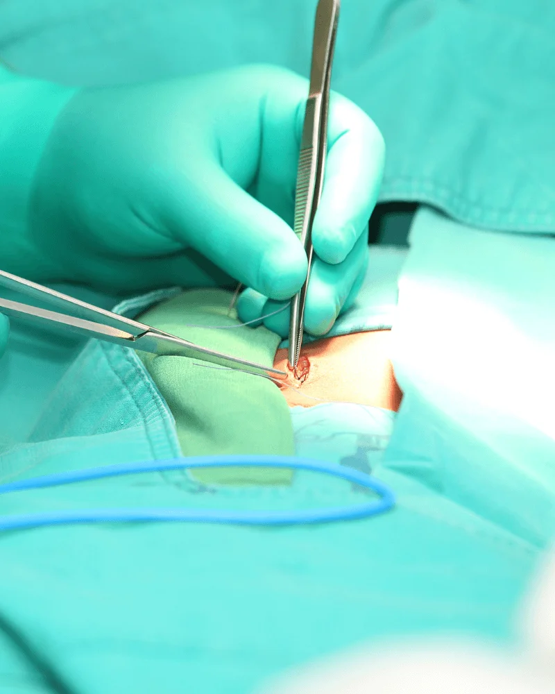 cirujano-de-hernias-en-Zapopan