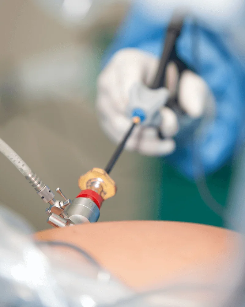 cirujano-de-hernias-en-Zapopan