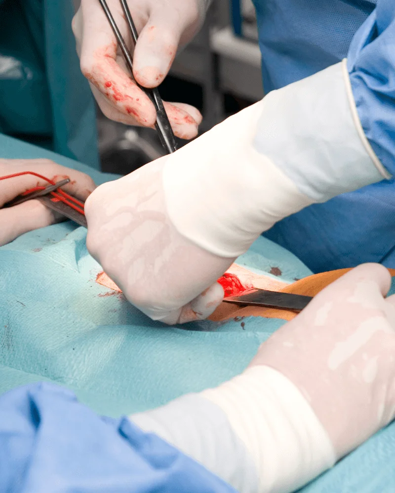 cirujano-de-hernias-en-Zapopan