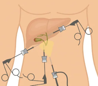 Colecistectomia Abierta o Laparoscópica