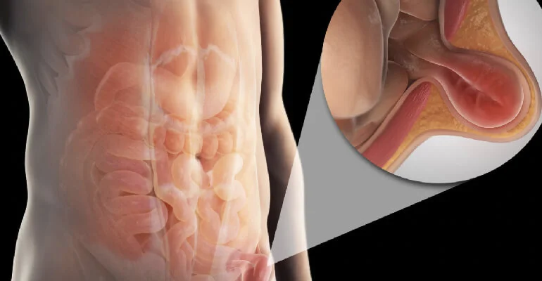 Hernioplastias de Pared abdominal